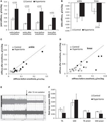 Spinal Hyper-Excitability and Altered Muscle Structure Contribute to Muscle Hypertonia in Newborns After Antenatal Hypoxia-Ischemia in a Rabbit Cerebral Palsy Model